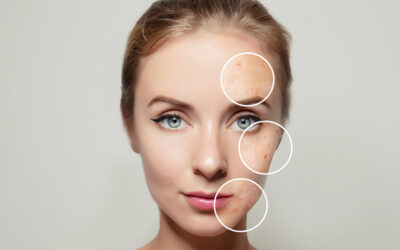 Prevenir les taques a la pell amb despigmentants